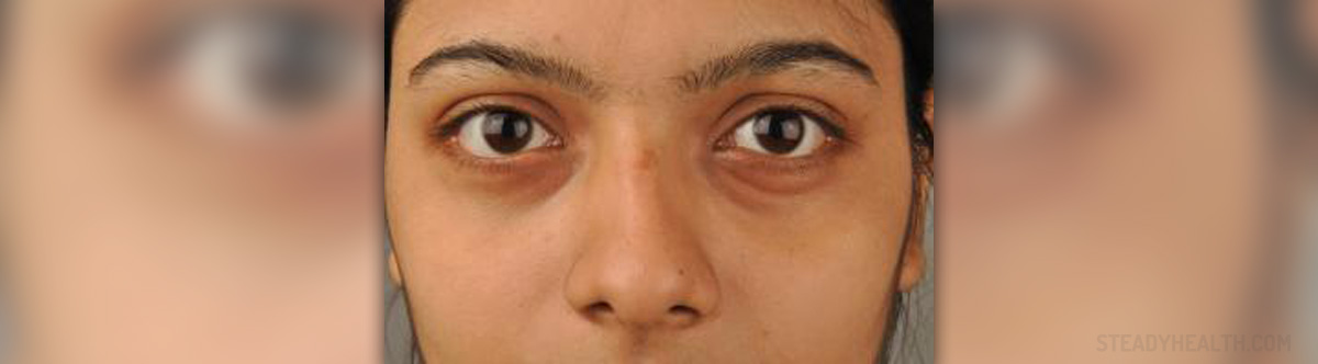 Bags under eyes causes | Eye Disorders and Diseases articles | Body ...