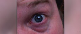 Banish baggy eyes and dark circles naturally