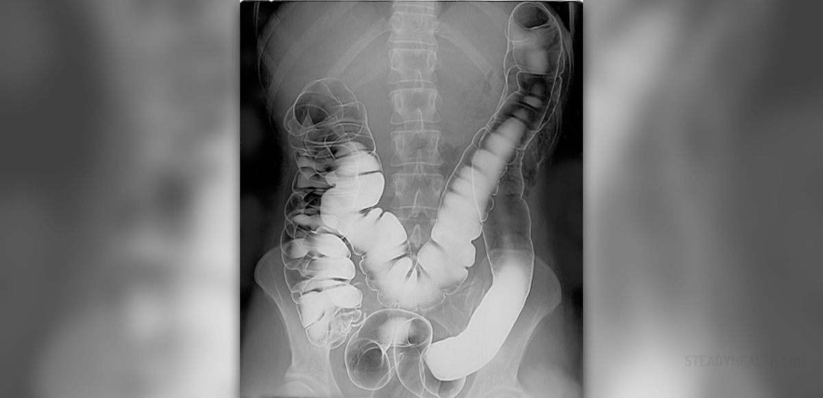 Barium enema procedure General center SteadyHealth com