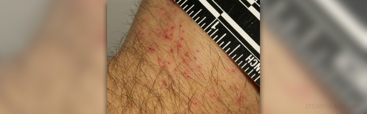 Bed bug marks on skin 