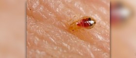 Bed bug bites treatment