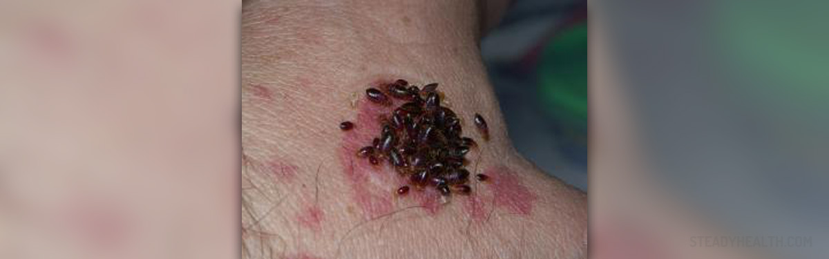 Bed Bugs Rash General Center