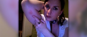 Bee stings, bug bites and poison ivy