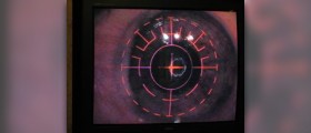 Benefits of laser eye surgery