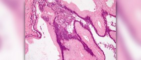 Benign essential tremor syndrome