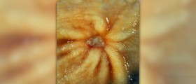 Benign fibroid tumors