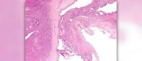 Benign germ cell tumor