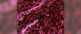 Benign junctional melanocytic nevus