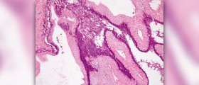 Benign longitudinal melanonychia