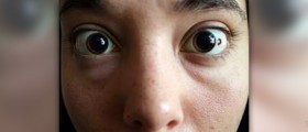 Benign melanocytic nevi