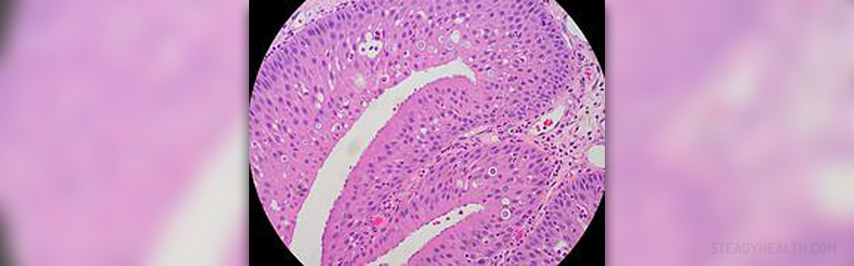 papilloma nasal icd 10