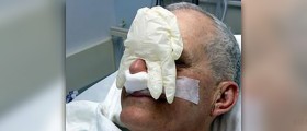 Benign nasal tumor