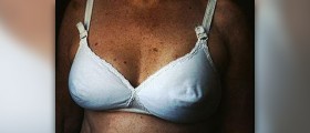 Benign nipple conditions