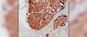 Benign nodules on thyroid
