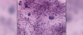 Benign pineal tumor