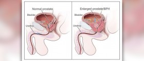 Benign positional vertigo exercises