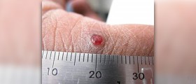 Benign pyogenic granuloma
