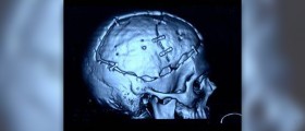 Benign radial scar