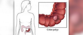 Benign rectal polyp