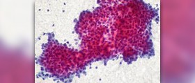 Benign salivary gland tumor