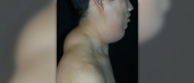 Benign sebaceous adenoma