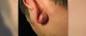 Benign sebaceous hyperplasia