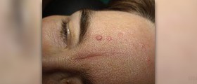 Benign seborrhoeic keratosis
