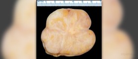 Benign tumor definition