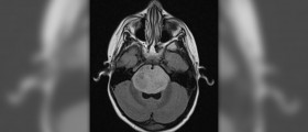 Benign tumor in brain
