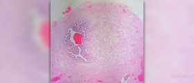 Benign tumor in breast