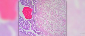 Benign tumor symptoms and diagnosis
