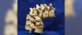Benign tumour on spine