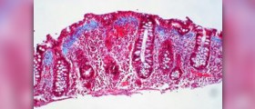 Best medication for colitis