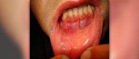Best medication for ulcers