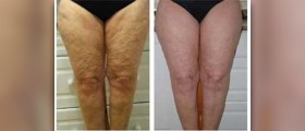 Best supplements for cellulite
