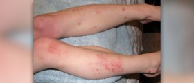 Best supplements for eczema