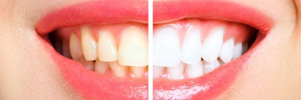 Best teeth whitening product - the best methods exposed