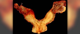 What is a bicornuate uterus?