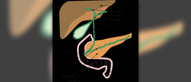 Biliary colic facts