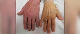 Birth defects as a signs of Fanconi anemia