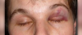Black eye remedies