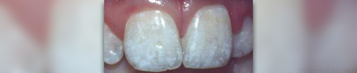 Black Spots On Teeth 