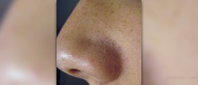 Blackhead removal - get rid of blackheads