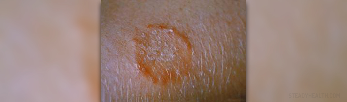 Bleach And Ringworm Does Bleach Kill Ringworm Quora Red Ring