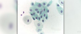 Bleeding after pap smear