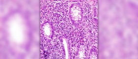 Bleeding stomach ulcer