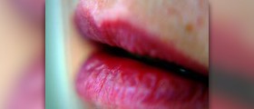 Blister on lip
