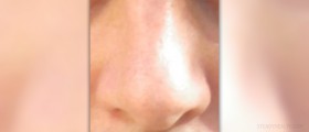 Blisters in nose