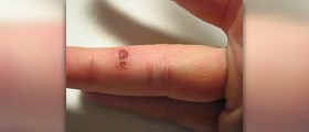 Blisters on fingers