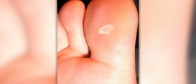 Blisters on toes
